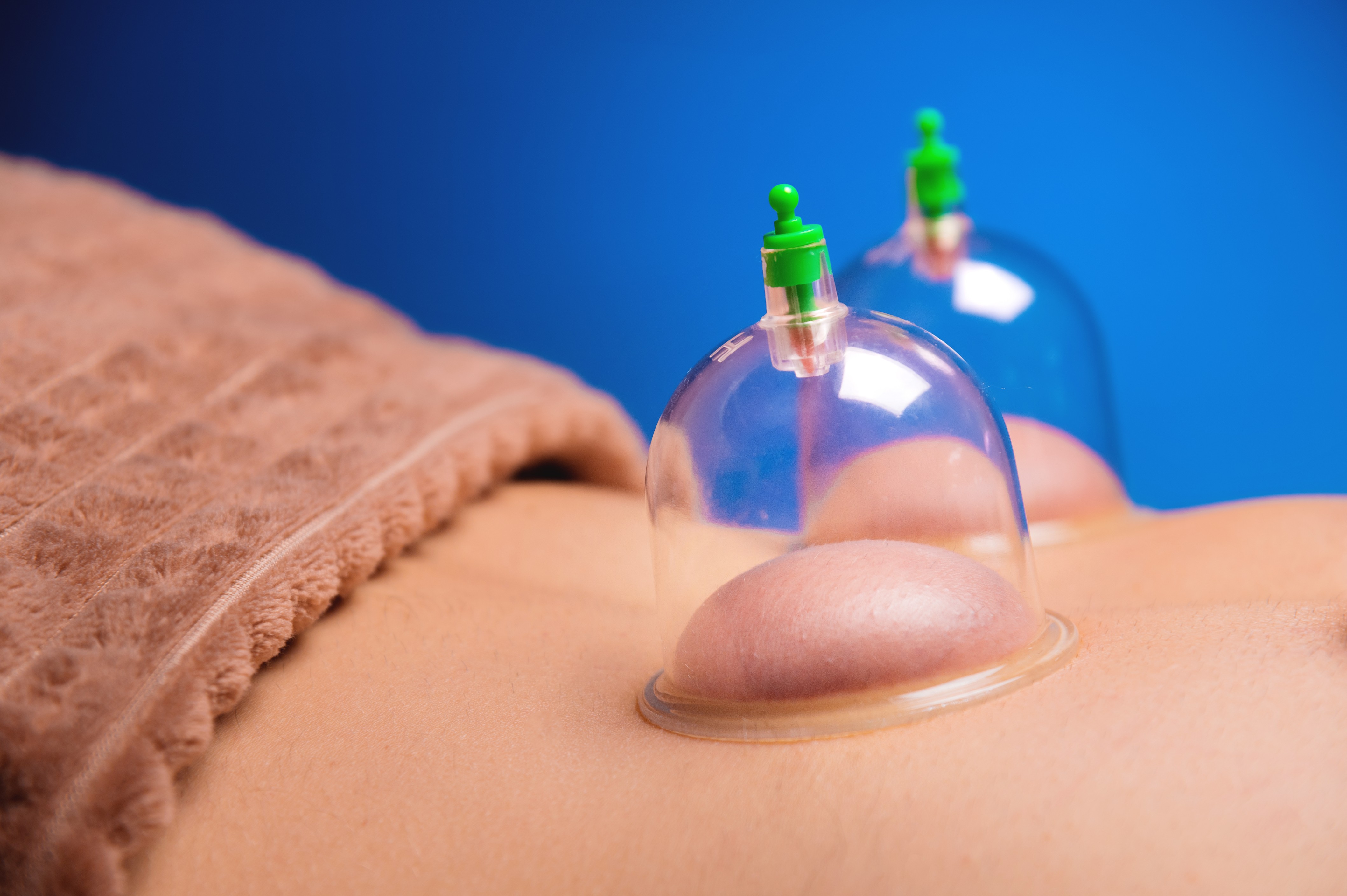 Cupping Therapy